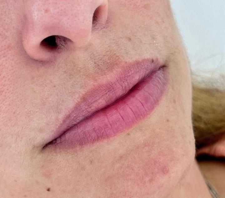 Antes do preenchimento labial