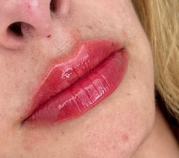 Resultado do preenchimento labial na JB Estética