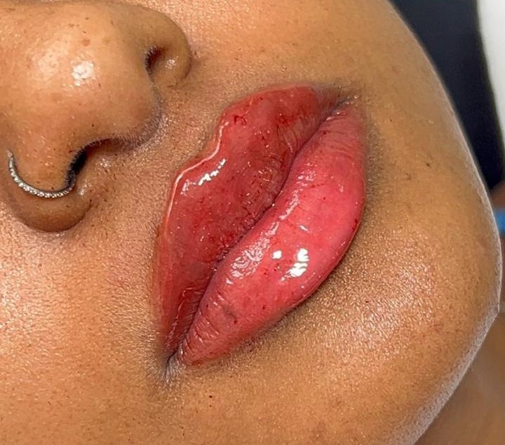 Resultado do preenchimento labial na JB Estética