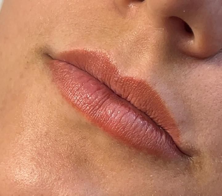 Antes do preenchimento labial