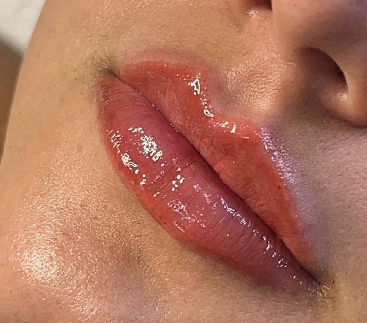 Resultado do preenchimento labial na JB Estética