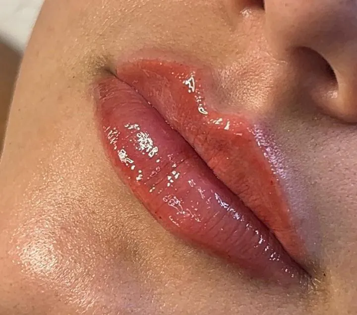 Resultado do preenchimento labial na JB Estética